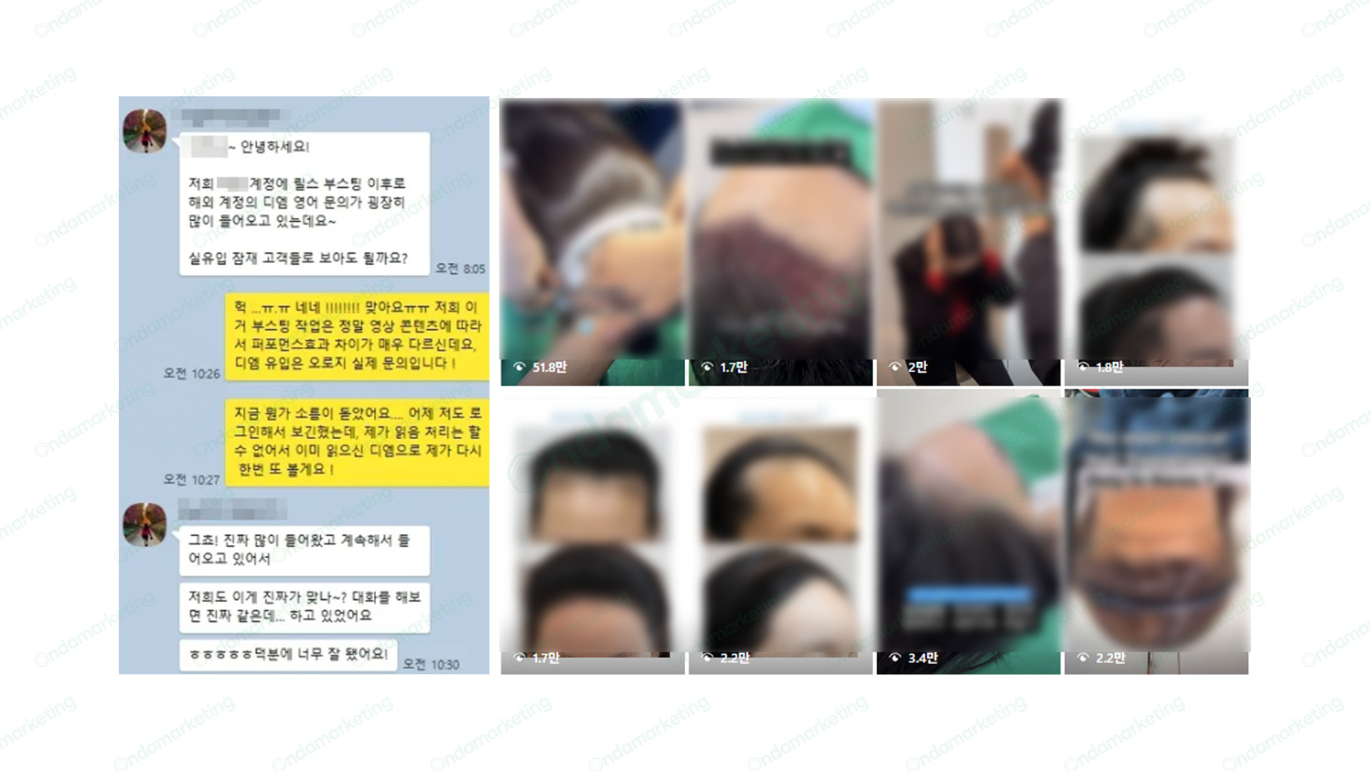 [릴스 부스팅] 모발이식 성형외과